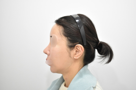 After — RESPECT Plastic Surgery