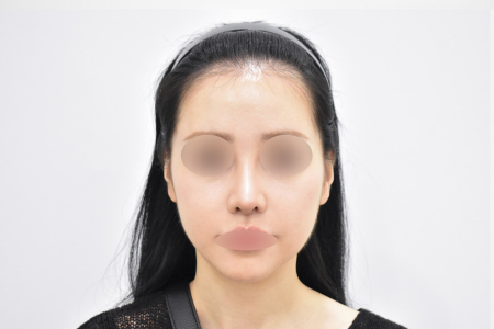 After — RESPECT Plastic Surgery