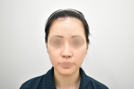 Before — RESPECT Plastic Surgery