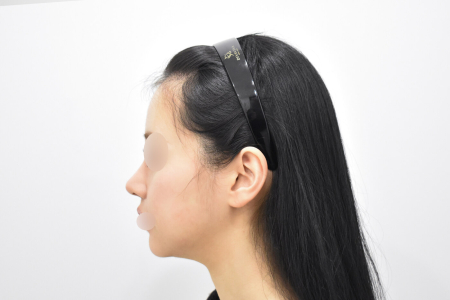 After — RESPECT Plastic Surgery