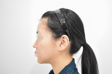Before — RESPECT Plastic Surgery