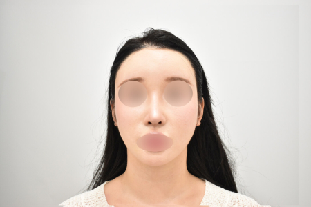 After — RESPECT Plastic Surgery