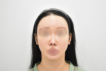 Before — RESPECT Plastic Surgery