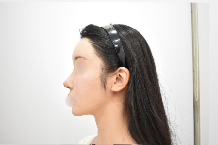 After — RESPECT Plastic Surgery