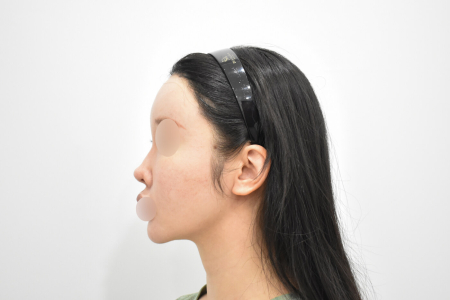 Before — RESPECT Plastic Surgery