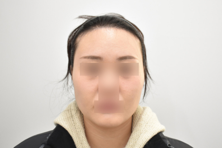 After — RESPECT Plastic Surgery