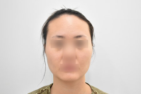 Before — RESPECT Plastic Surgery