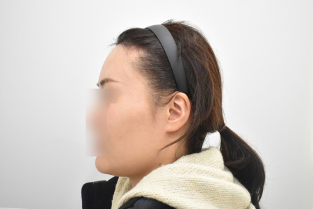 After — RESPECT Plastic Surgery