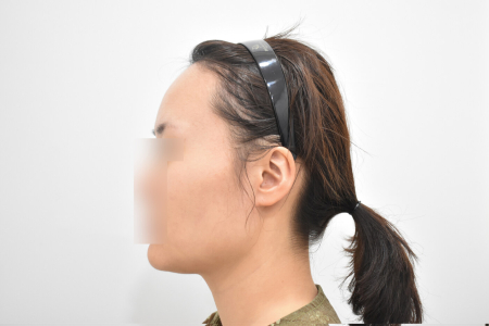 Before — RESPECT Plastic Surgery