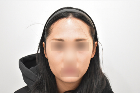 After — RESPECT Plastic Surgery