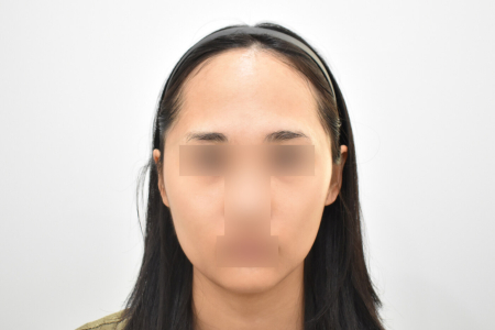 Before — RESPECT Plastic Surgery