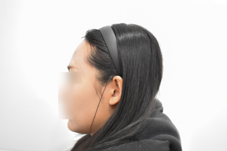 After — RESPECT Plastic Surgery