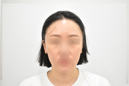After — RESPECT Plastic Surgery