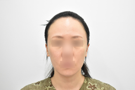 Before — RESPECT Plastic Surgery