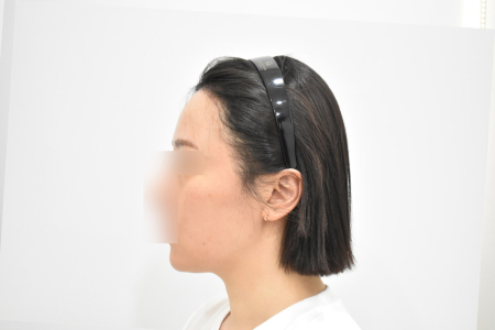 After — RESPECT Plastic Surgery