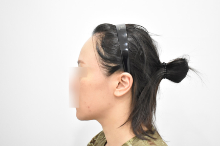 Before — RESPECT Plastic Surgery