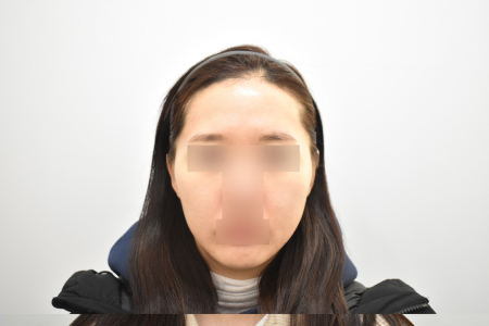 After — RESPECT Plastic Surgery