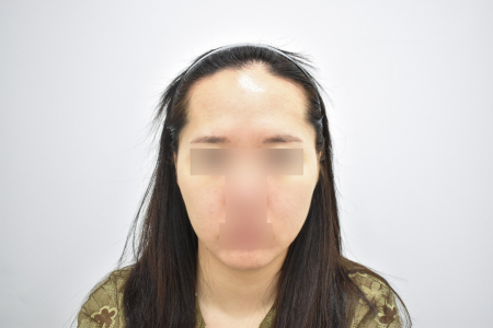 Before — RESPECT Plastic Surgery