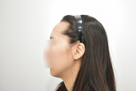 Before — RESPECT Plastic Surgery