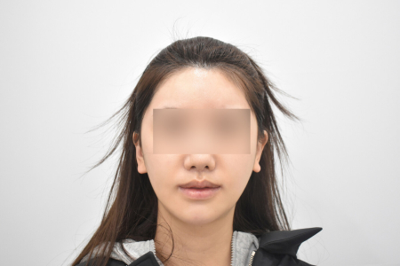 After — RESPECT Plastic Surgery