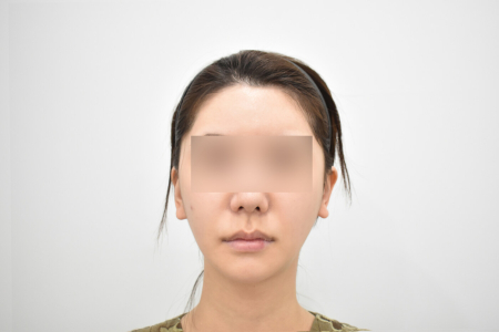 Before — RESPECT Plastic Surgery