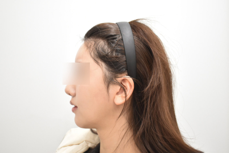 After — RESPECT Plastic Surgery
