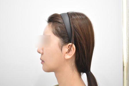 Before — RESPECT Plastic Surgery