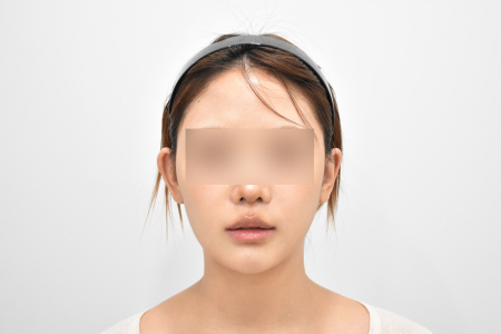 After — RESPECT Plastic Surgery