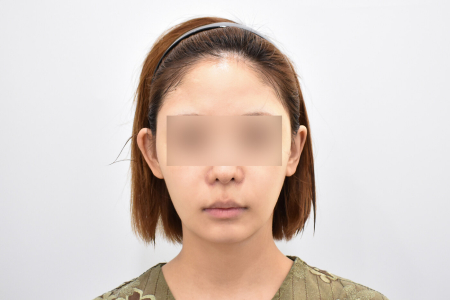 Before — RESPECT Plastic Surgery