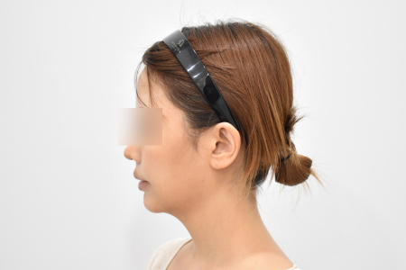 After — RESPECT Plastic Surgery