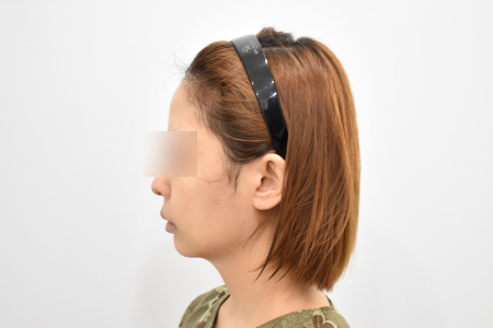 Before — RESPECT Plastic Surgery