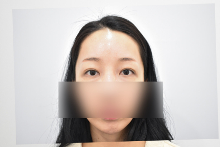 After — RESPECT Plastic Surgery