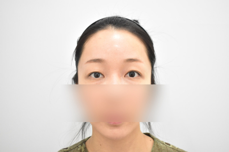Before — RESPECT Plastic Surgery
