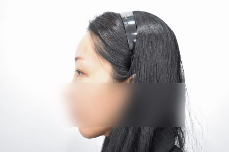 After — RESPECT Plastic Surgery