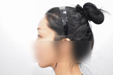 Before — RESPECT Plastic Surgery