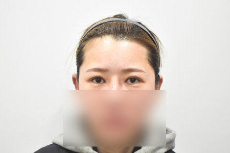 After — RESPECT Plastic Surgery