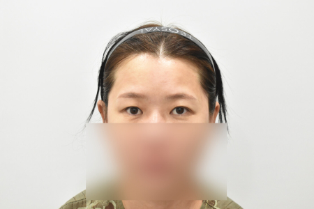 Before — RESPECT Plastic Surgery
