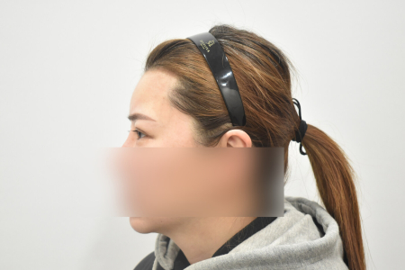 After — RESPECT Plastic Surgery