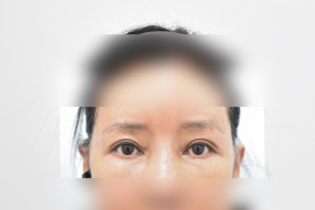 After — RESPECT Plastic Surgery