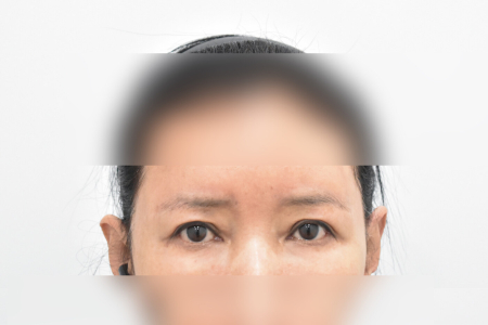 Before — RESPECT Plastic Surgery