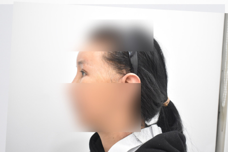After — RESPECT Plastic Surgery