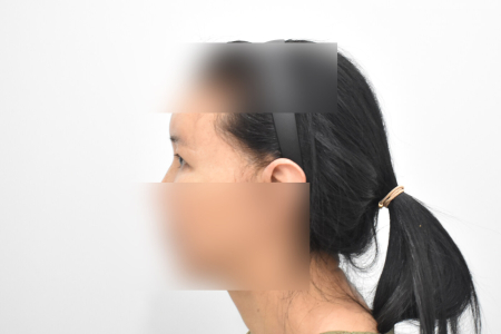 Before — RESPECT Plastic Surgery