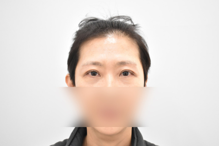 After — RESPECT Plastic Surgery