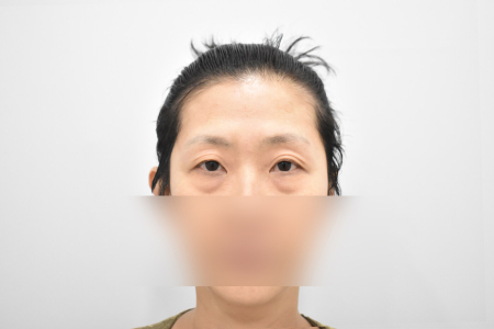 Before — RESPECT Plastic Surgery
