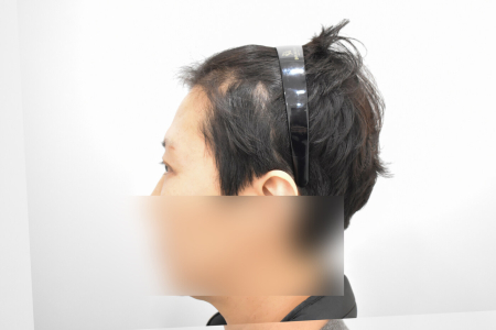 After — RESPECT Plastic Surgery