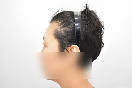 Before — RESPECT Plastic Surgery