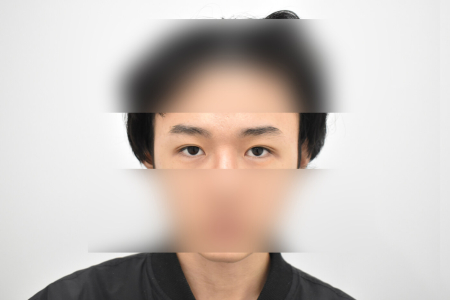 After — RESPECT Plastic Surgery