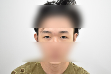 Before — RESPECT Plastic Surgery