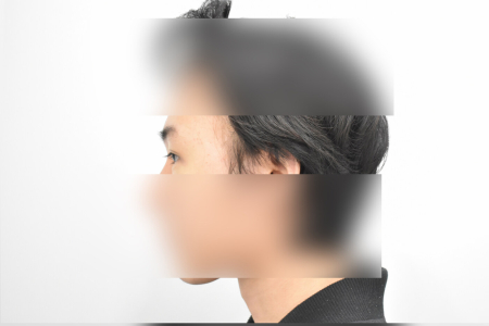 After — RESPECT Plastic Surgery