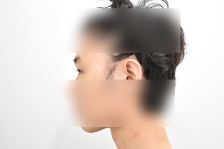 Before — RESPECT Plastic Surgery